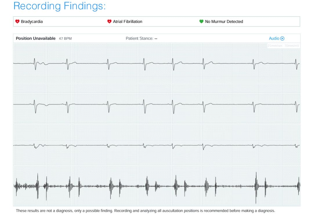Eko CORE 500 Digital Stethoscope - 40x Amplification, Active Noise Cancellation, 3-Lead ECG, FDA-Cleared AI with Eko+, Full-Color Display, Reimbursement Eligible - Silver, COR503-SLV customer photo 1