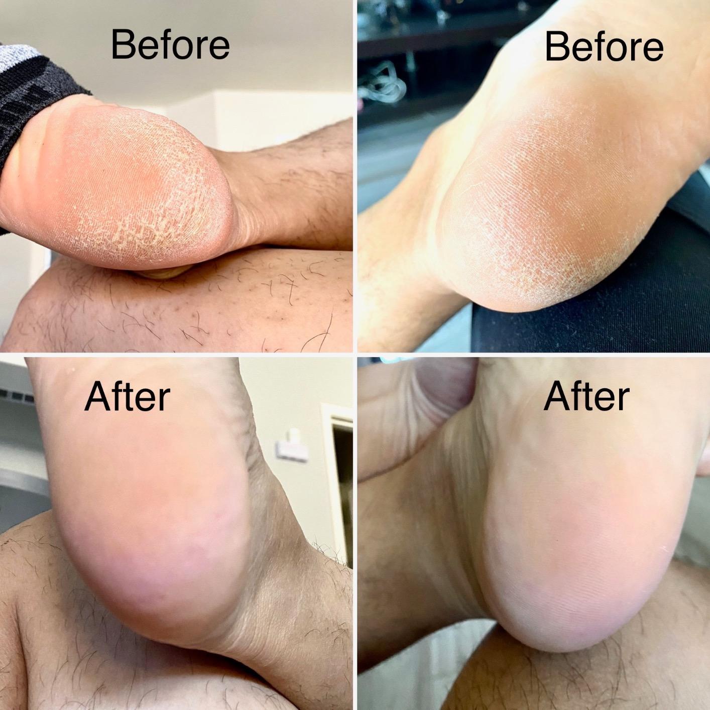 Electric Foot Callus Remover Kit, Elmchee Rechargeable Callous removers 3 Grinding Heads Waterproof Foot Scrubber File, Professional Pedicure Tools kit Feet Care for Dead, Cracked Dry Skin customer photo 2