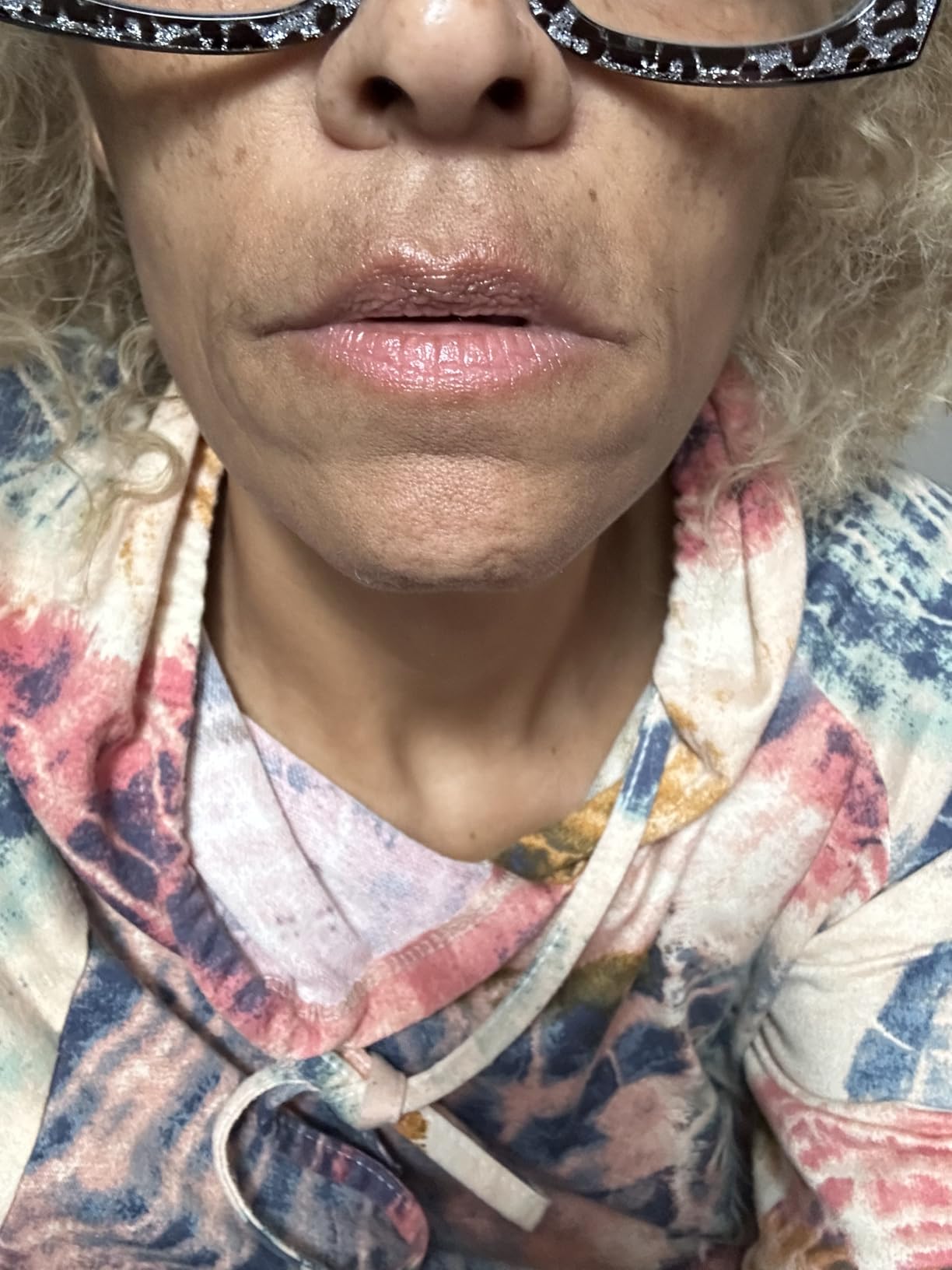 High Frequency Facial Wand/Machine with 5 Argon Parts Skin Care Tool for Wrinkles Reducing Face Skin Tightening. customer photo 2